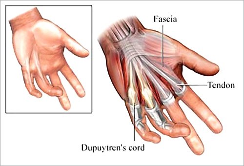 Массаж при фиксационных, а также рубцовых контрактурах
